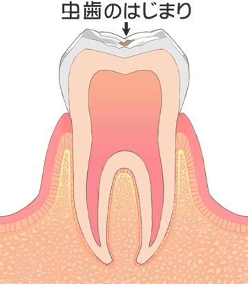 虫歯の始まり