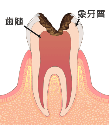 C3虫歯後期